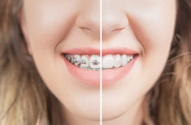 5. Prednosti ispravljanja zuba